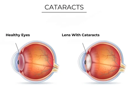 Comparison of healthy eye and eye with cataracts